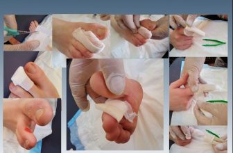 Ways to bandage finger and toes