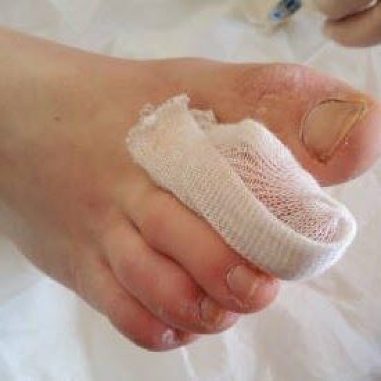 Bandaging Toes First Aid Wound Care