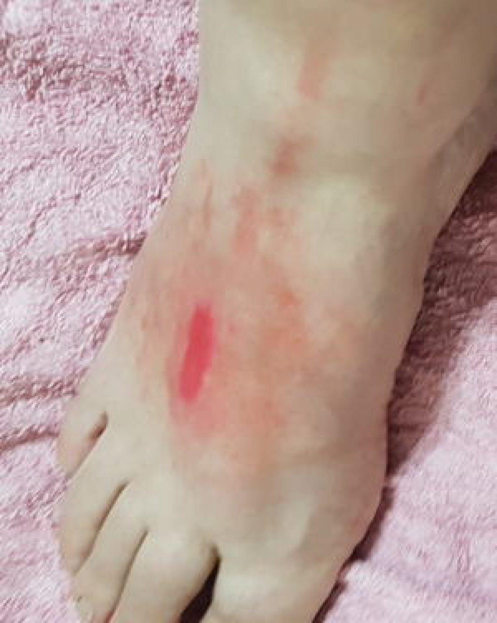 Antiseptics – First Aid Wound Care
