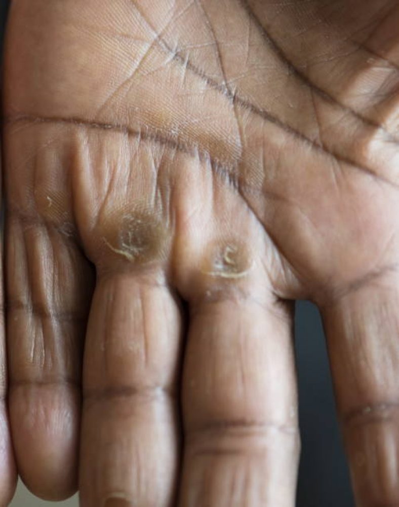 No More Rowers Hand Sores Secrets To Achieving PainFree Hands First